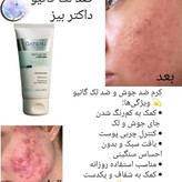 کرم ژل آنتی آکنه (ضدجوش و ضد لک) گاتیو اصل از بین برندهانواع لک و جای جوش - ۴۰ میل